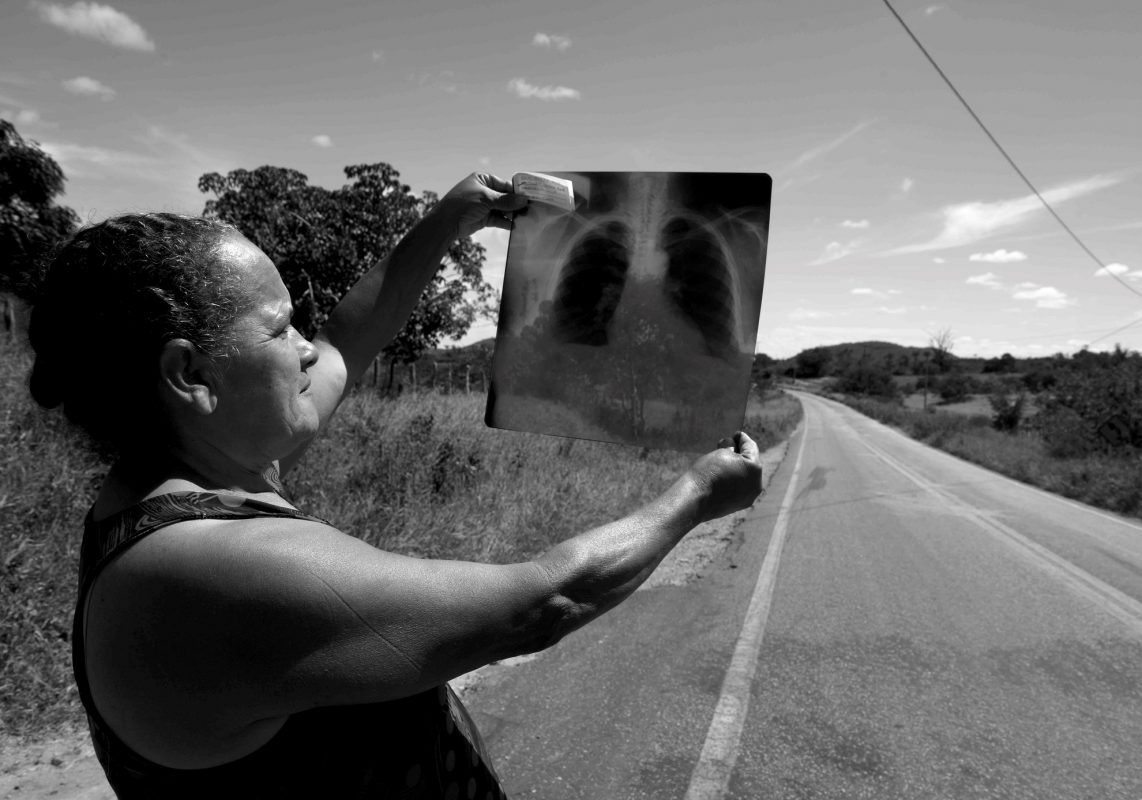 Credes Cardoso mostra o raio-X de suas placas pleurais: vítima do amianto mesmo sem ter trabalhado na mina (Foto: Inácio Teixeira/Coperphoto)